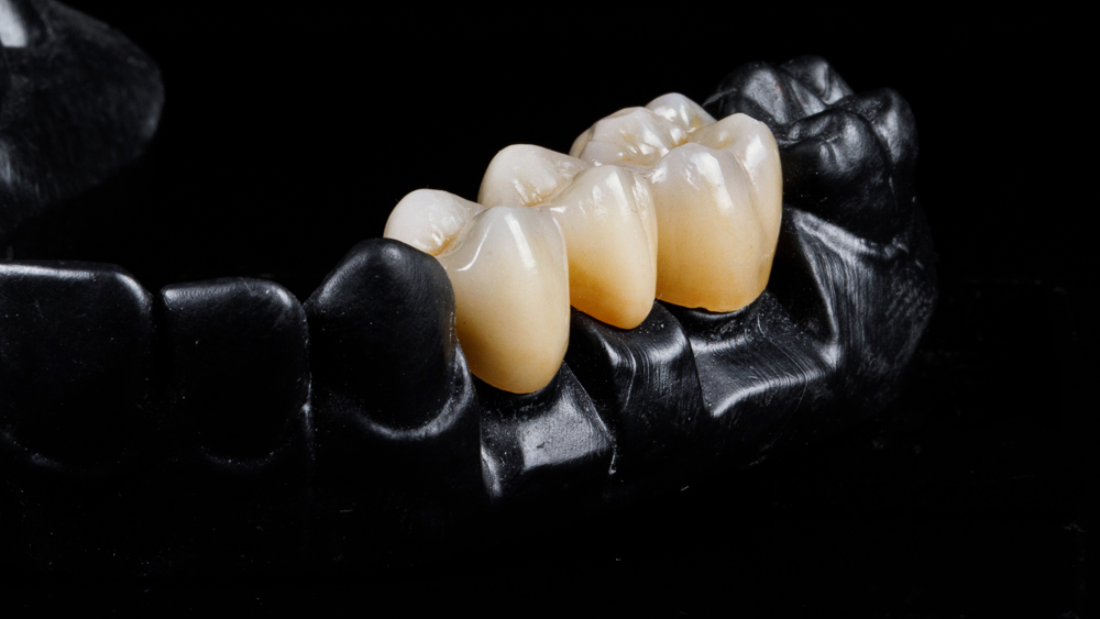 Baker Dental Lab_Service_crown-and-bridge