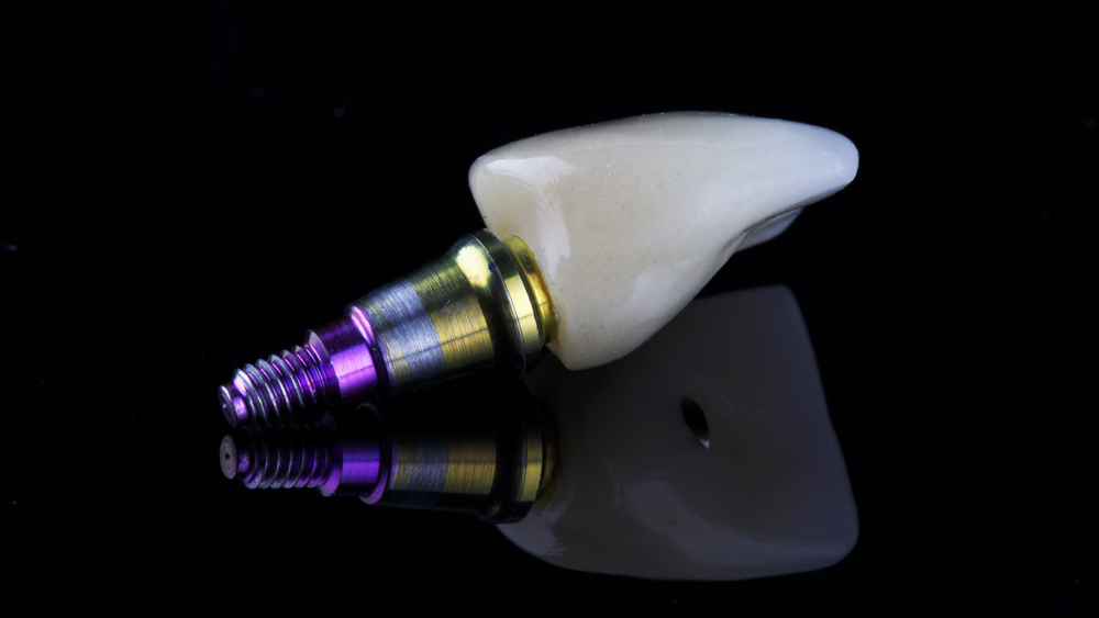 Baker Dental Lab_Service_custom-abutments